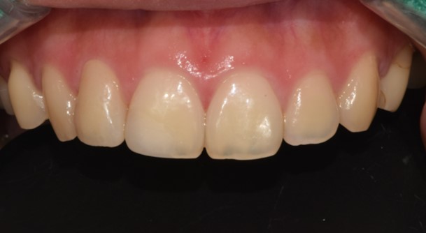 After image