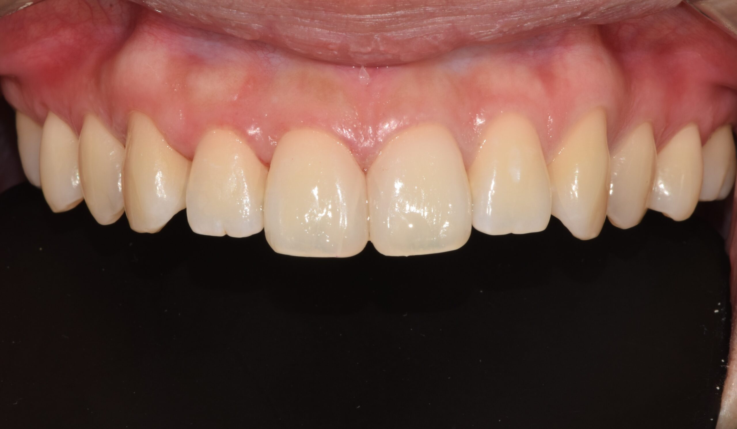 After image
