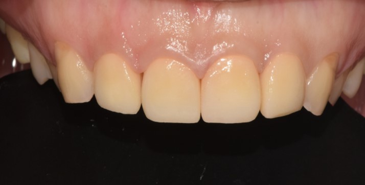After image